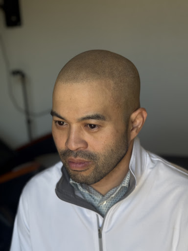 Fort Worth Scalp Micropigmentation